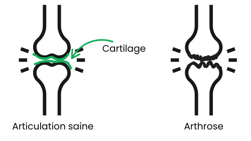 schéma qui explique la différence entre une articulation saine et une articulation avec artrhose